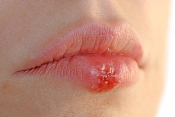Герпес на губах у ребенка: причины, симптомы, лечение