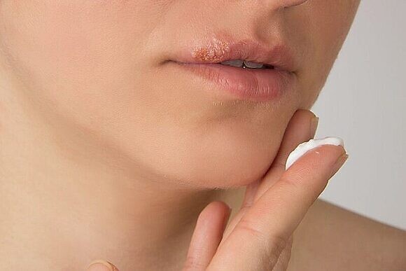 Симптомы и причины герпеса на губах