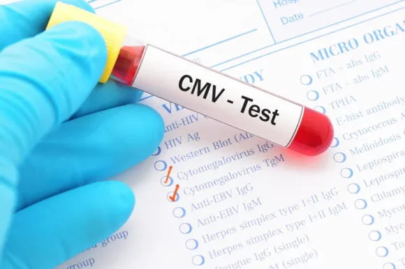 Цитомегаловирус: симптомы и лечение ЦМВ-5