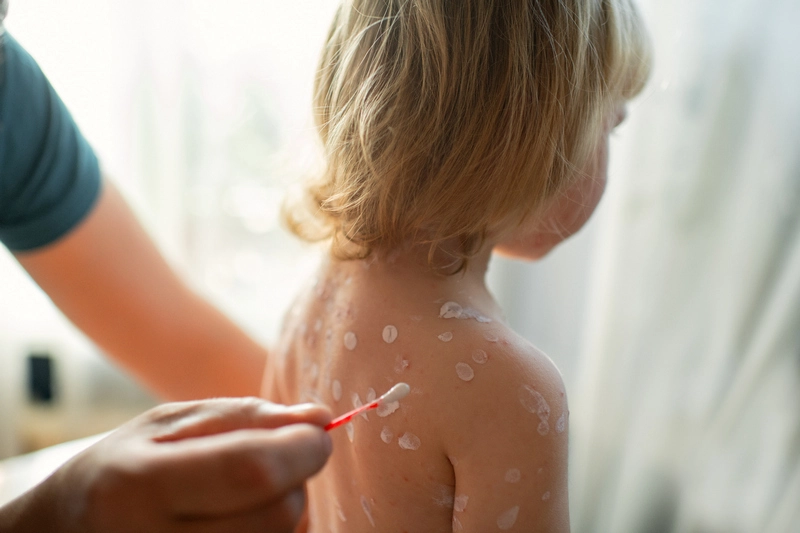 Ветрянка: симптомы, лечение и профилактика