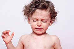 Атопический дерматит у детей-1